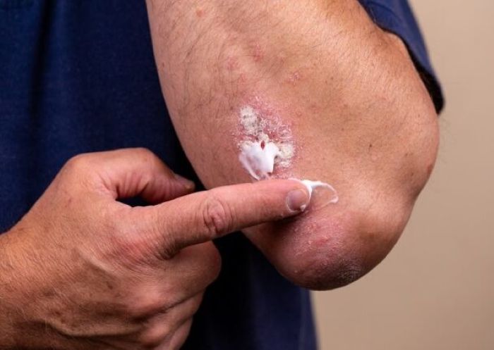 Menggunakan Salep Anti Bakteri Sebagai Cara Mengeluarkan Luka Pada Nanah - Photo by Google