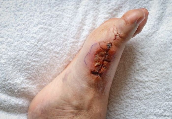 Cara Mengeluarkan Nanah Pada Luka Dengan Operasi - Photo by Alodokter